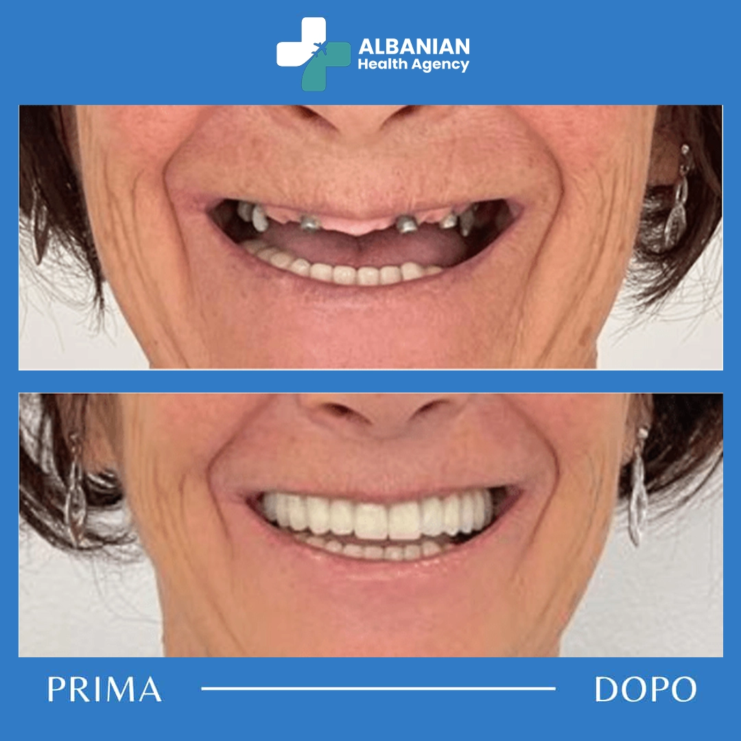 Patient showing before and after results of zirconia crowns during dental tourism in Albania.