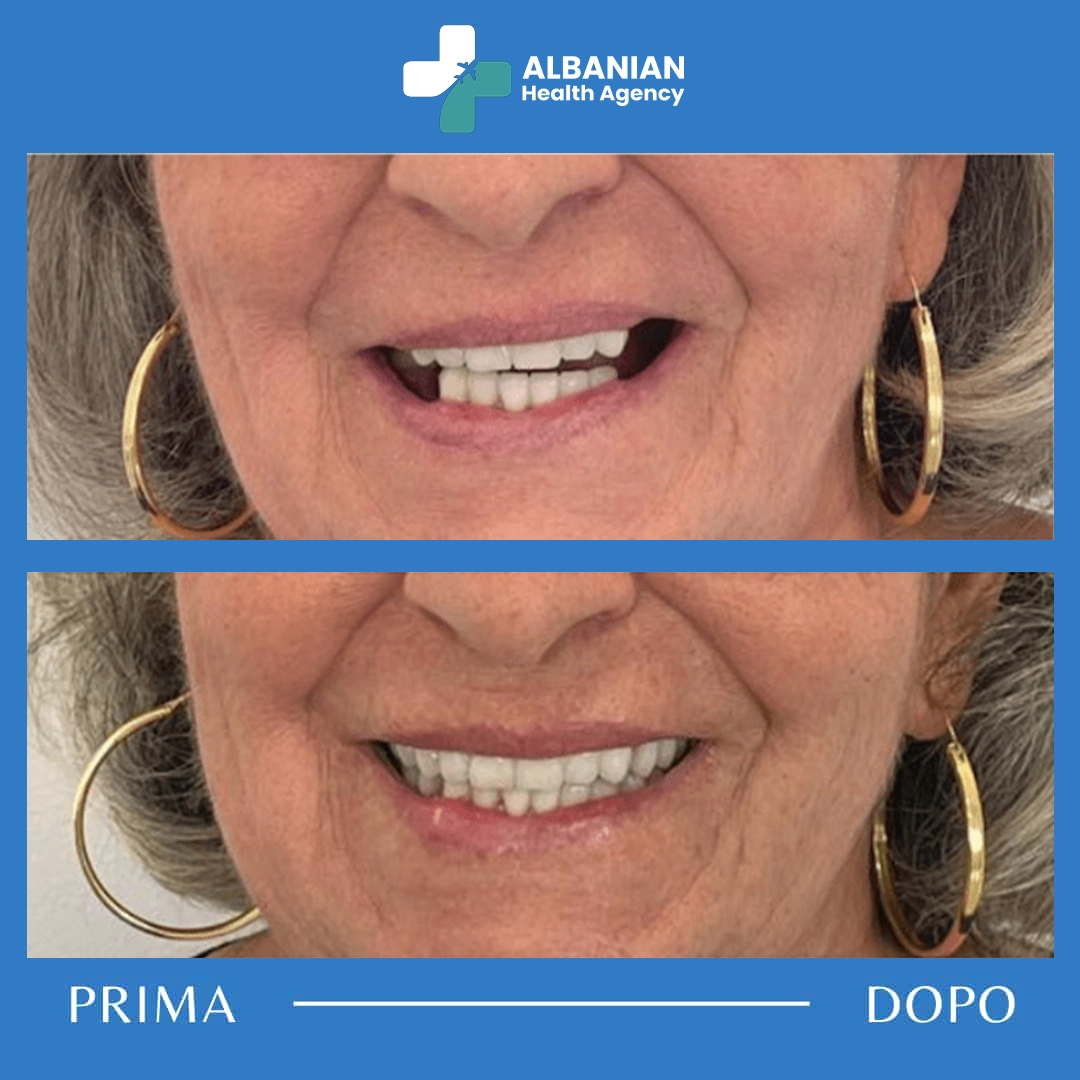 Smile makeover before and after composite bonding in a top Albanian dental clinic.