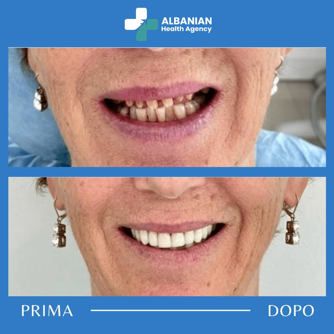 Before and after results of a dental implant procedure during dental tourism in Albania.