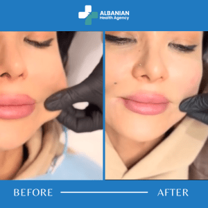 Botox & Non-Surgical Lifting