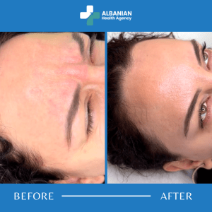 Botox & Non-Surgical Lifting