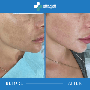 Skin Rejuvenation in Albania