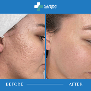 Skin Rejuvenation in Albania