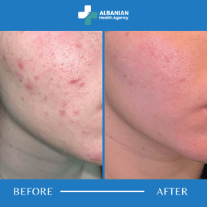 Skin Rejuvenation in Albania