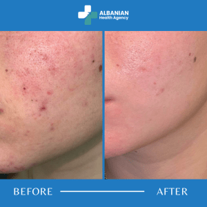 Skin Rejuvenation in Albania