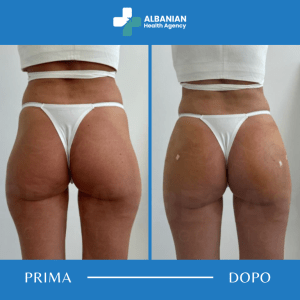 Trattamenti corpo in Albania