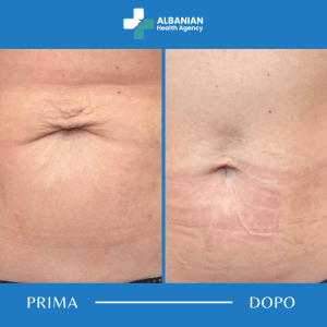 Trattamenti corpo in Albania