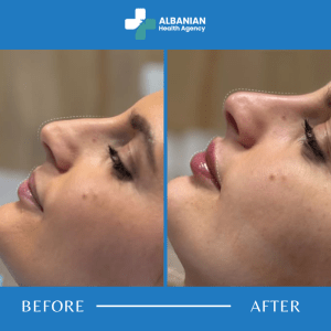 Facial Contouring in Albania