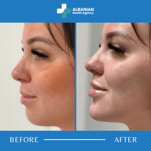 Facial Contouring in Albania