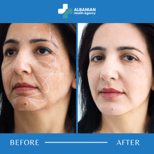 Lip And Wrinkle Treatments