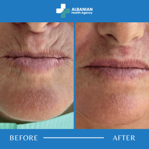 Lip And Wrinkle Treatments