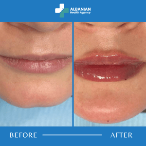 Lip And Wrinkle Treatments