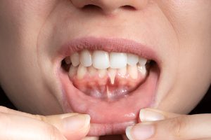 Scopri le cause delle gengive ritirate, i migliori rimedi e trattamenti efficaci per prevenire e curare la recessione gengivale.