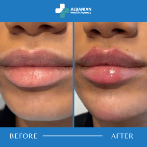 Lip And Wrinkle Treatments