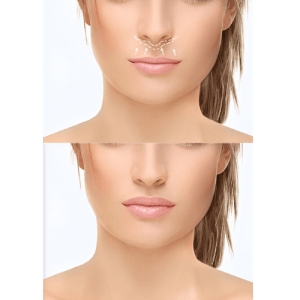 Lip & Chin Contouring