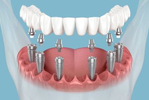 All on 6 dental implants involve the placement of six titanium implants in the jawbone, serving as a strong foundation for a full-arch prosthesis.