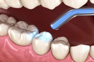 Discover the top 3 proven tooth restoration techniques to restore your smile. Learn about fillings, crowns, and implants today!