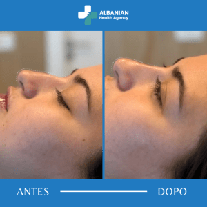 Contorno Facial en Albania