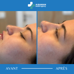 Remodelage du visage en Albanie