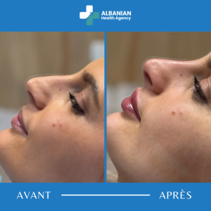 Remodelage du visage en Albanie