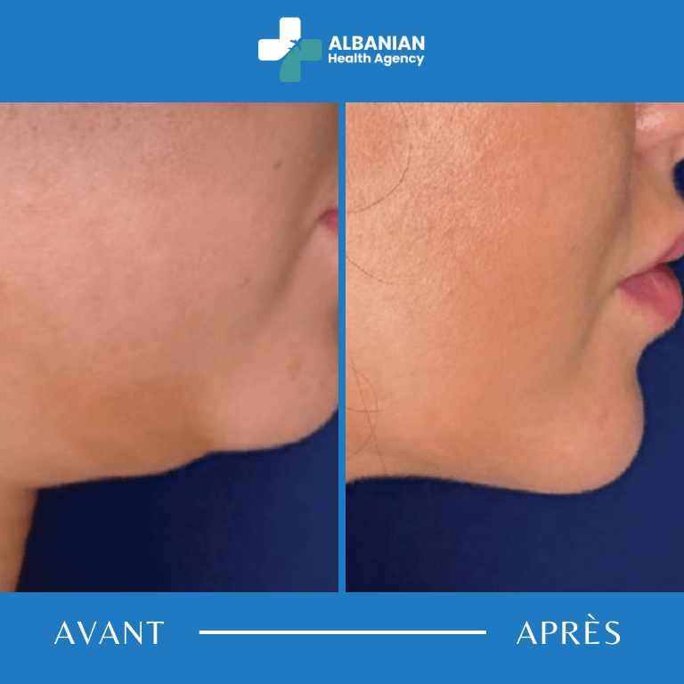 Chirurgie faciale en Albanie