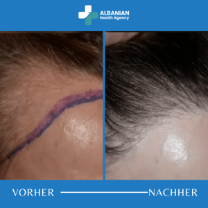 Haartransplantation Frauen Albanien
