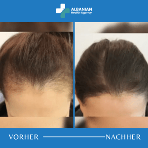 Haartransplantation Frauen Albanien