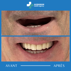 Implants dentaires en Albanie