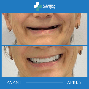 Implants dentaires en Albanie
