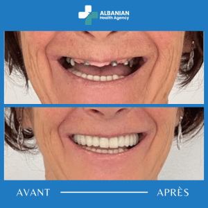 Implants dentaires en Albanie