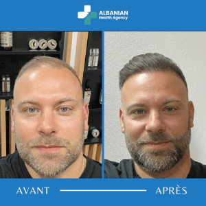 Greffe de cheveux DHI Albanie