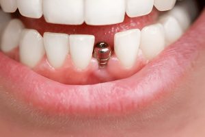 Scopri quanto dura il gonfiore dopo un impianto dentale, perché si verifica e come gestirlo al meglio. Leggi i consigli degli esperti.