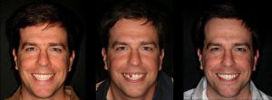 Ed Helms before and after dental implants