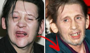 Shane MacGowan before and after teeth