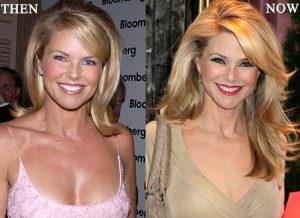 Christie Brinkley before and after dental implants