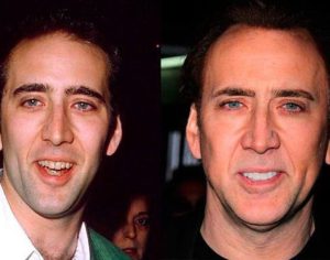 Nicolas Cage before and after teeth