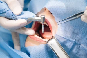 Explore whether dental implants are painful, understand the procedure, recovery, and expert insights to alleviate concerns.