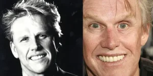 Gary Busey before and after teeth