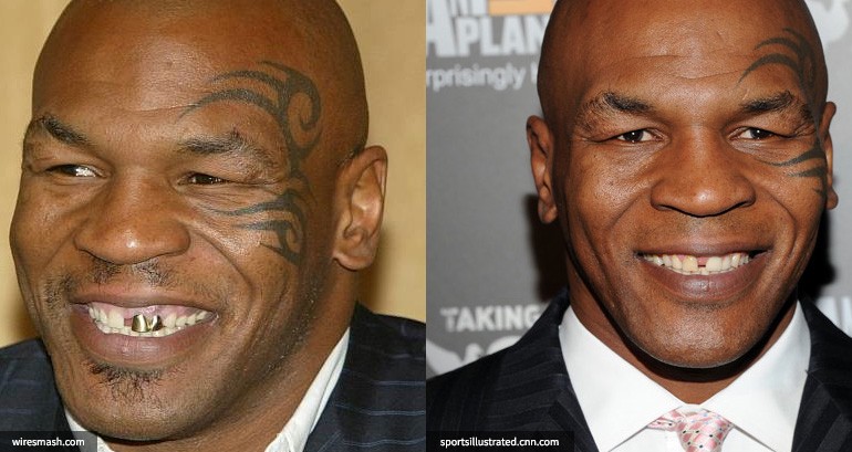 mike tyson before and after teeth work