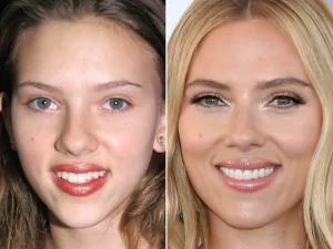 Scarlett Johansson’s dental transformation was subtle at first. She began with a single veneer to correct a tooth edge. Over the years, however, her smile evolved dramatically. Photos show she eventually covered most of her front teeth with veneers. Cosmetic dentist Dr. Kevin Sands, who has worked with numerous celebrities, explains that full-arch veneers can help harmonize a smile, especially for actors constantly under HD camera scrutiny.