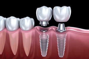 copri cosa fare dopo un impianto dentale per assicurarti una guarigione perfetta. Segui i consigli di esperti odontoiatri.