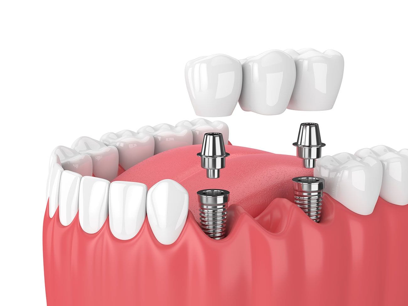 Scopri i prezzi degli impianti dentali in Albania, le opzioni disponibili e i vantaggi del turismo odontoiatrico nel 2025.