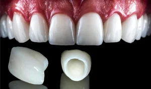 Discover the key differences between zirconia crown vs porcelain. Learn about durability, aesthetics, cost, and expert recommendations.