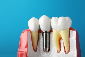 Explore the comprehensive comparison of dental implants vs dentures to determine the best tooth replacement option for your needs.