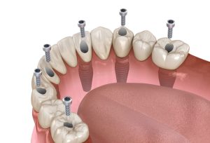 : Explore the differences between All-on-4 vs All-on-6 dental implants to determine the best solution for your dental restoration needs.