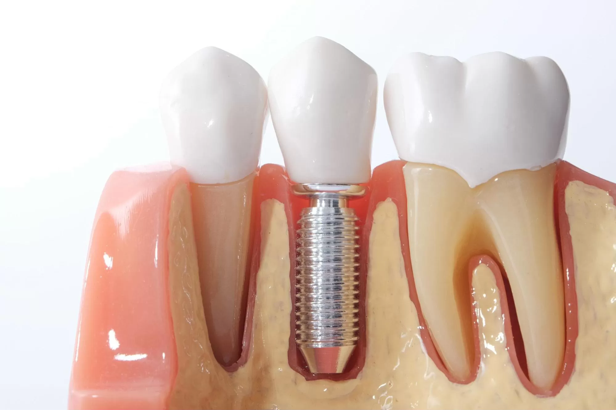 A janë të dhimbshme implantet dentare? Udhëzues i plotë për pacientët në Shqipëri