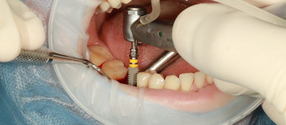 Scopri cosa fare se l’impianto dentale non si attacca e come affrontare questo problema. Consigli medici e soluzioni sicuri.