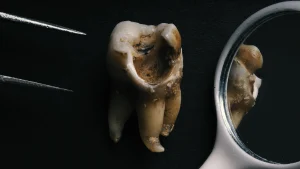 Come Capire se un Dente è Cariato
