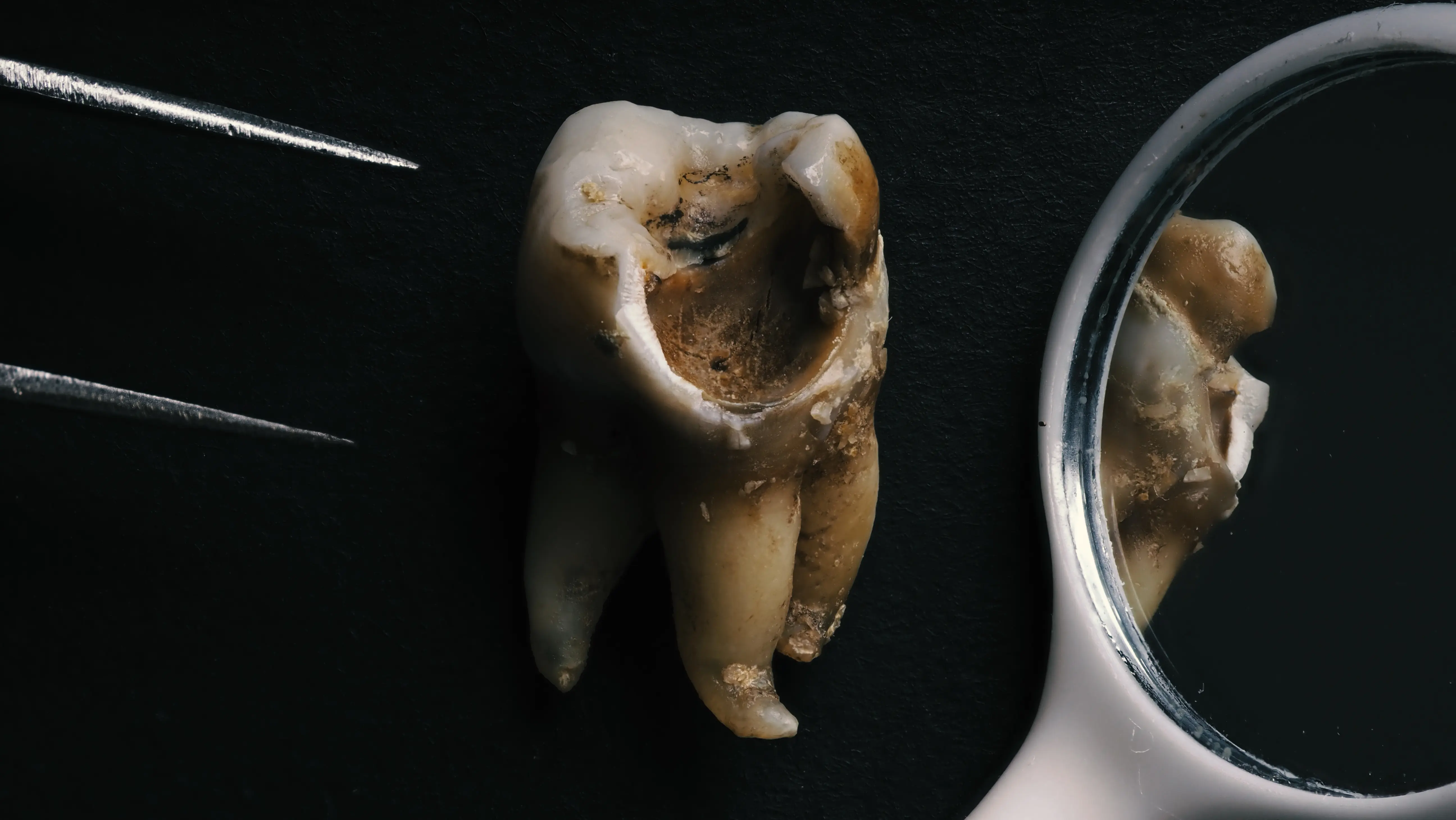 Come Capire se un Dente è Cariato