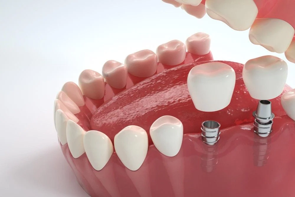 Pas vendosjes së një implanti dentar, dieta është thelbësore. Mësoni çfarë të hani, çfarë të shmangni dhe si të përshpejtoni shërimin.